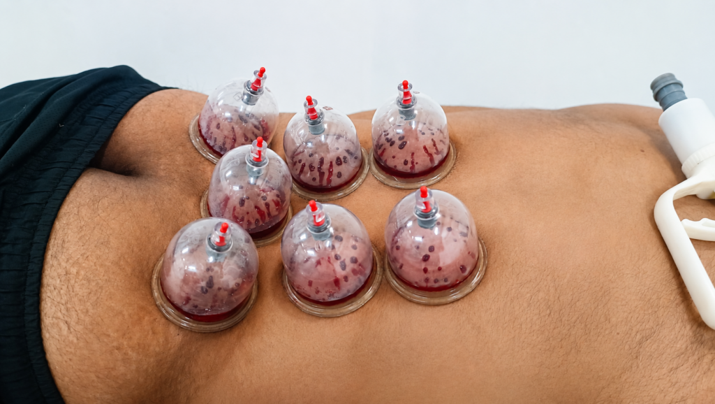 Hijama therapy treatment for back pain relief at Spine Chiropractic Osteopathic Clinic